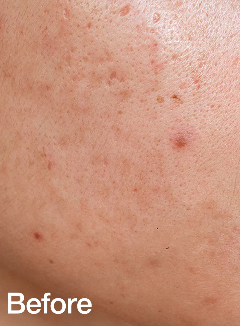Tónico Calmante Anua Heartleaf 77% Soothing Toner