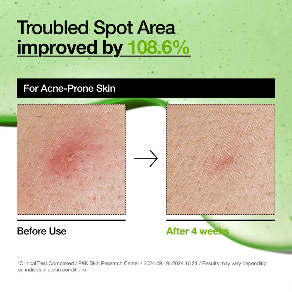 Sérum Anti-rojeces con Ácido Azelaico 10% y Ácido Hialurónico Anua Azelaic Acid 10 Hyaluron Redness Soothing Serum 30ml