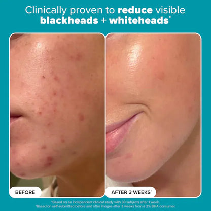 Exfoliante piel perfecta Paula’s Choice  2% BHA Liquid Exfoliant 118 ml