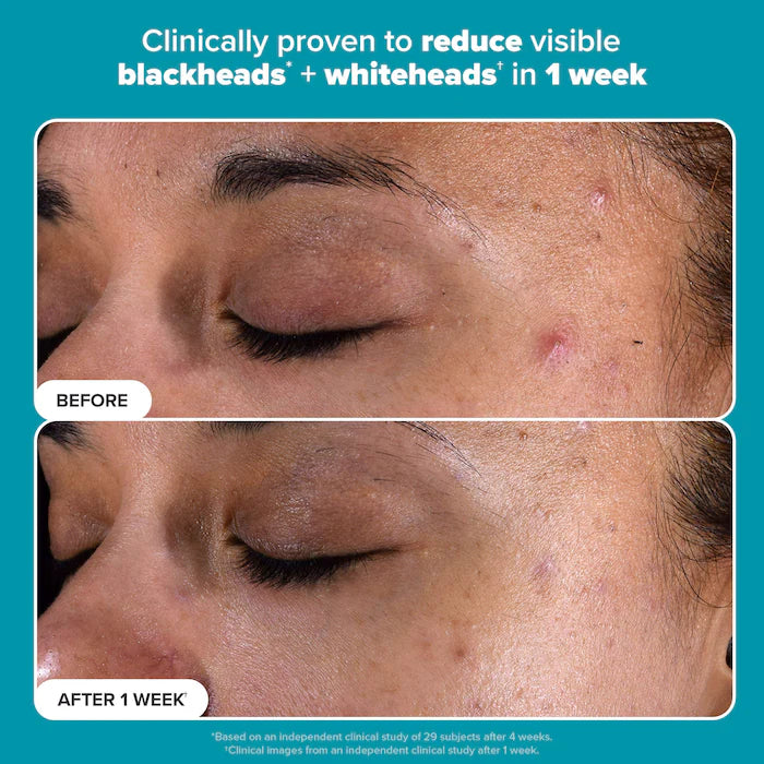 Exfoliante piel perfecta Paula’s Choice  2% BHA Liquid Exfoliant 118 ml
